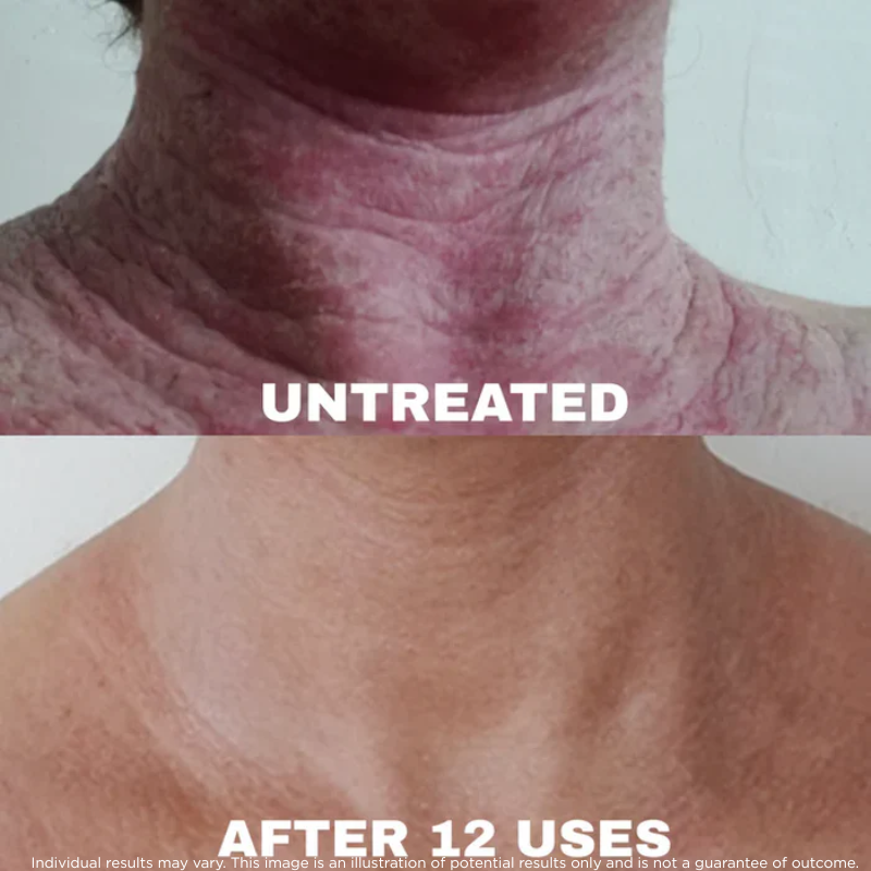 Ocean™ - Sea Moss Eczema Complex