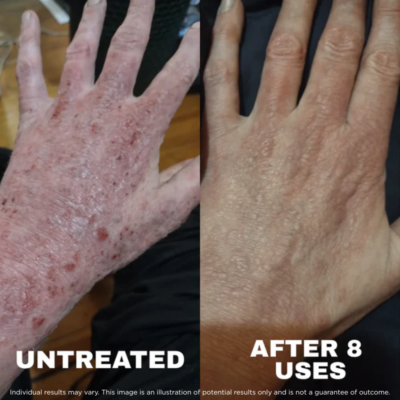 Ocean™ - Sea Moss Eczema Complex